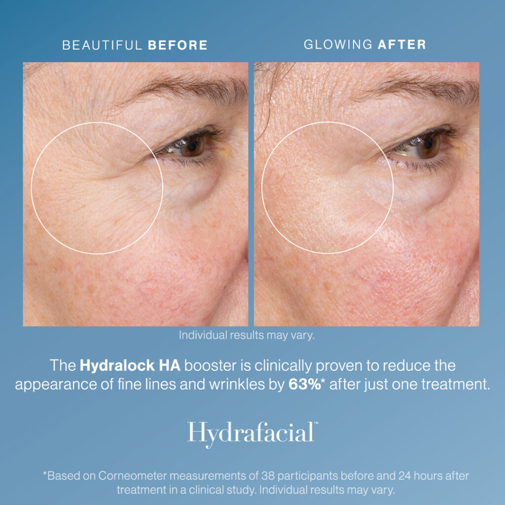 Hydralock_Before_After_2